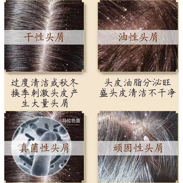 头皮屑成因分类：干性头皮屑 vs 马拉色菌过度繁殖