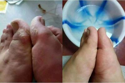 脚气反反复复怎么去根，脚气反复发作如何治疗