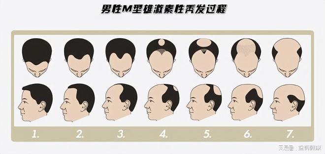 防脱发指南：区分正常掉发、休止期脱发与雄激素性脱发